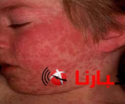 الحصبه الالمانيه